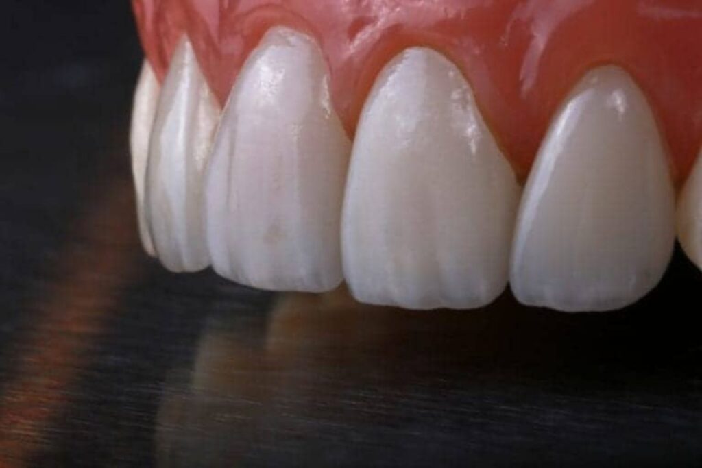 Zirconia & Emax Crown