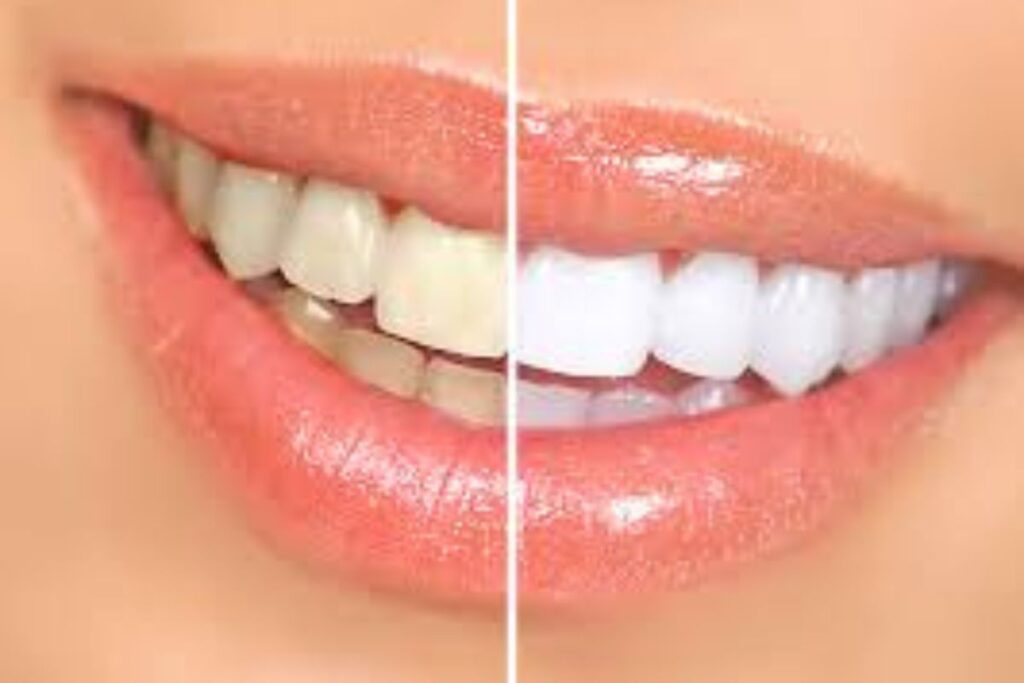 Teeth Whitening​