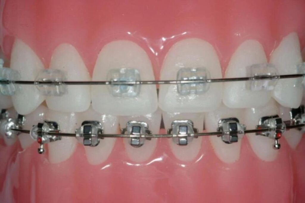 Orthodontic Braces