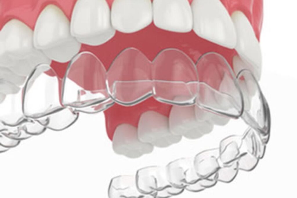 Invisalign Clear Aligner