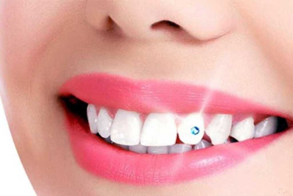 Dental Jewellery​