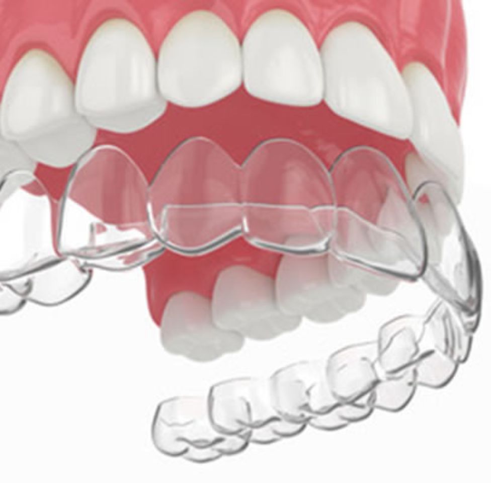 Invisalign Treatment Service in Bangladesh