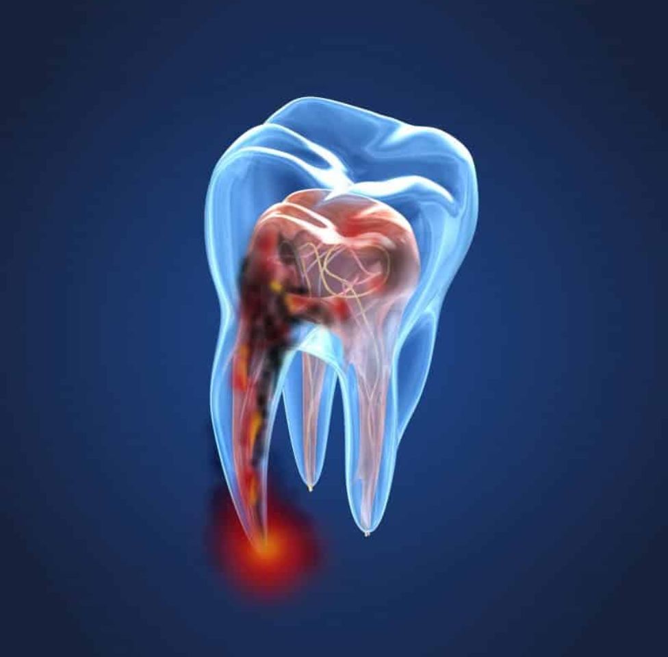 Root Canal Treatment In Bangladesh