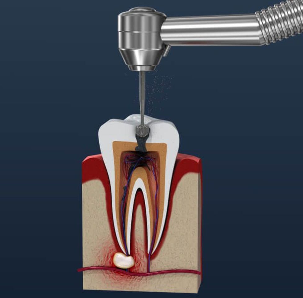 Understanding Root Canal Treatment​