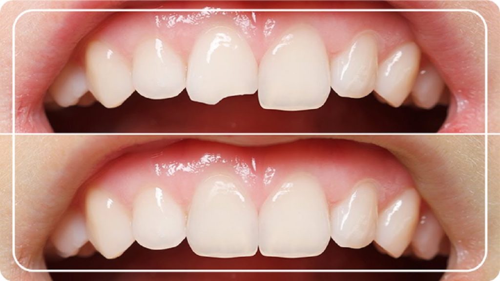 tooth filling cost in bangladesh