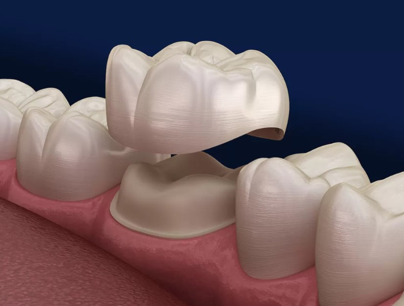 Dental Crowns