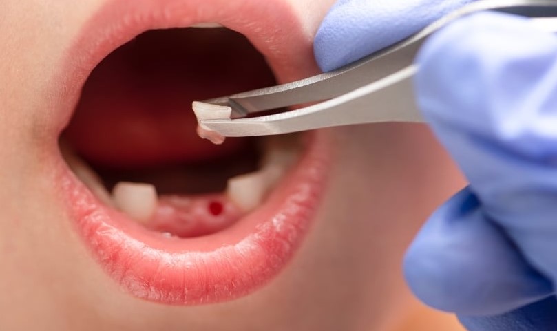 tooth extraction cost in bangladesh