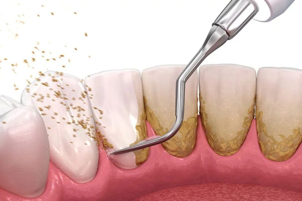 Dental Scaling & Polishing In Bangladesh